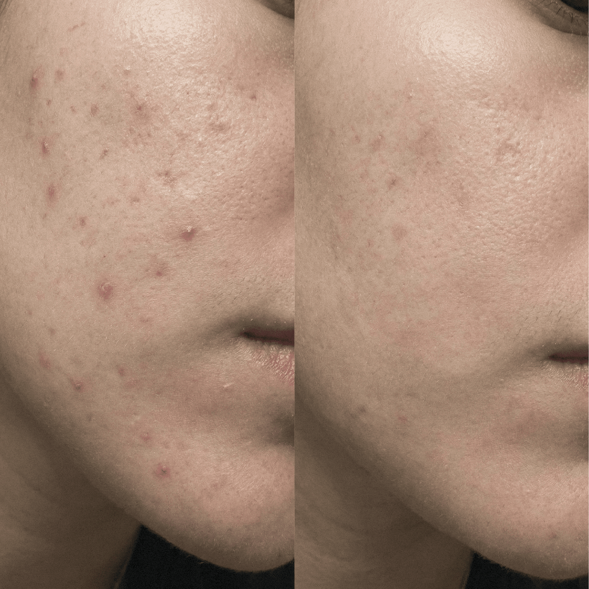 Κρέμα CBD Blemish Purity για επιρρεπές σε ακμή δέρμα