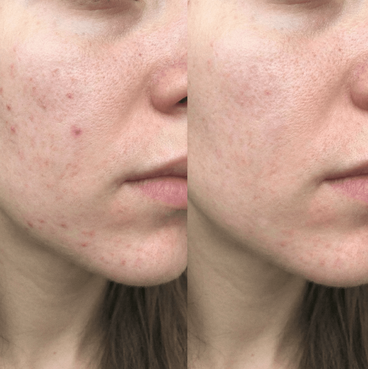 Κρέμα CBD Blemish Purity για επιρρεπές σε ακμή δέρμα