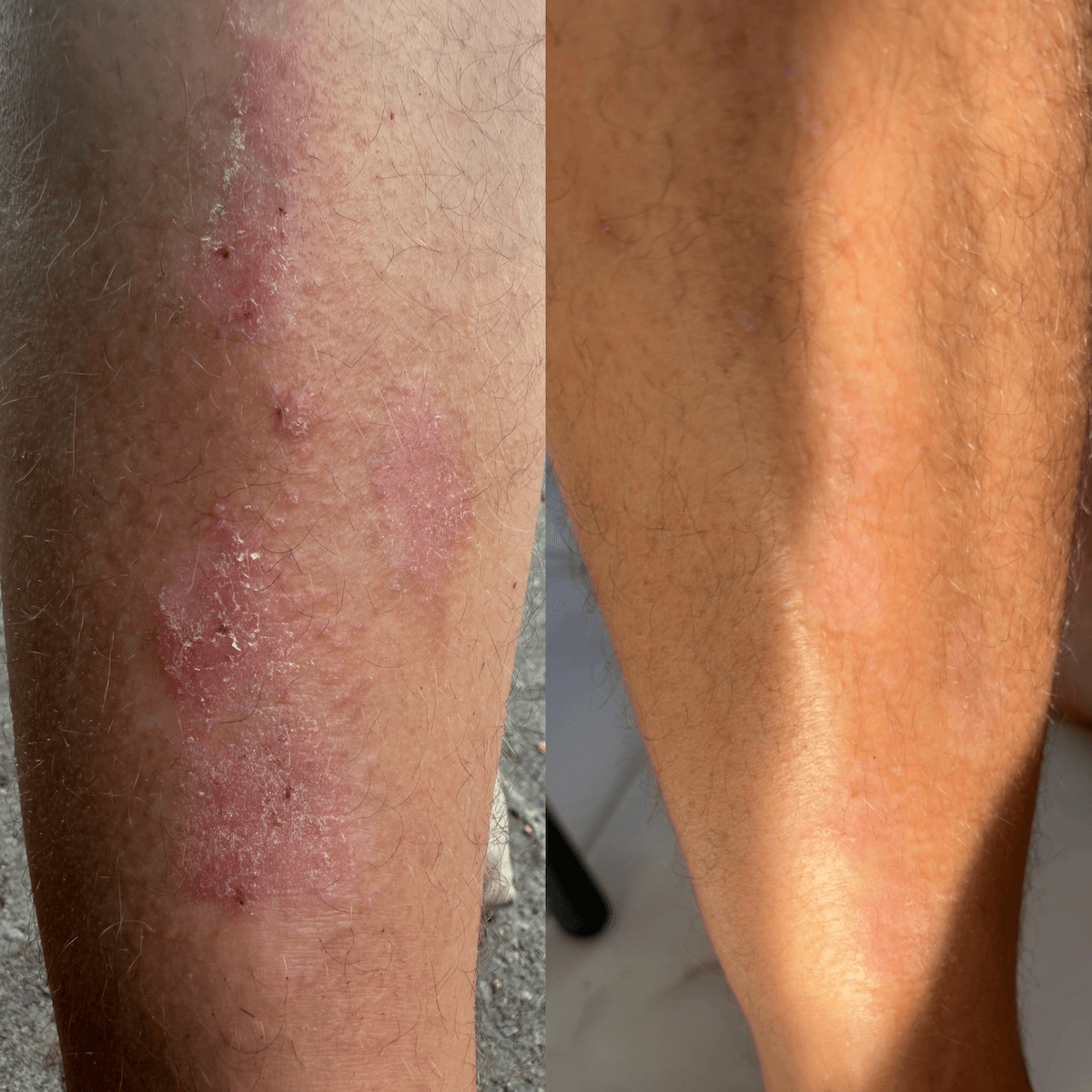 Επανορθωτική Κρέμα CBD για ξηρό δέρμα με τάση ψωρίασης